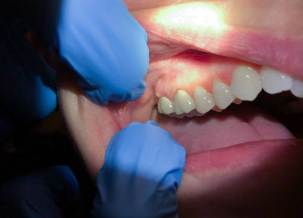 Best Emergency Wisdom Teeth Removal in Noroton, CT